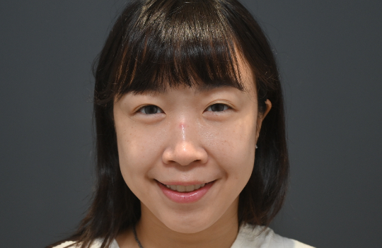 佳飛雅緻美學｜蜂巢皮秒｜施欣辰02